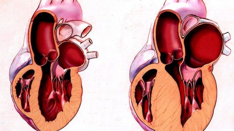 Bệnh tim to có nguy hiểm không? Triệu chứng và điều trị