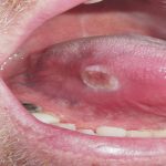 Bệnh ung thư khoang miệng có chữa được không?