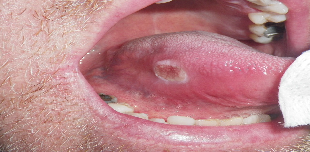 Phương pháp điều trị nào được áp dụng cho bệnh nhân ung thư miệng giai đoạn cuối?
