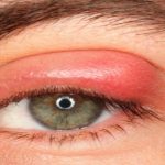 Viêm bờ mi mắt có nguy hiểm không?