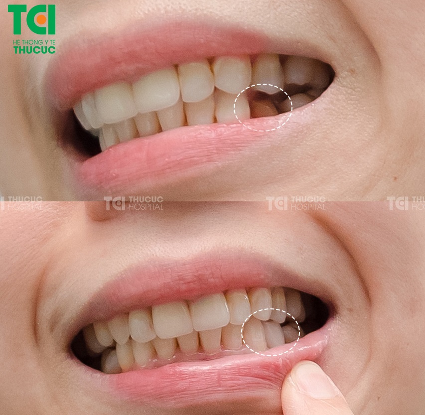  Bọc sứ chữa sâu răng giúp bệnh nhân bảo vệ được răng cũ khỏi các tác nhân gây sâu răng