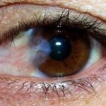 Mắt bị bong võng mạc điều trị bao lâu thì khỏi?