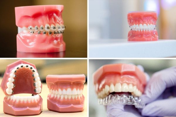 Đa dạng các loại niềng răng và chi phí giúp mọi người có thể lựa chọn phương pháp phù hợp với bản thân