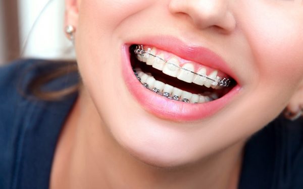 Niềng răng là thuật ngữ được sử dụng rộng rãi trong lĩnh vực nha khoa nhằm để chỉ kỹ thuật chỉnh nha, khắc phục sai lệch ở răng