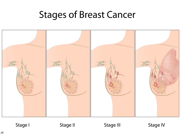 Cách chữa ung thư vú như thế nào?