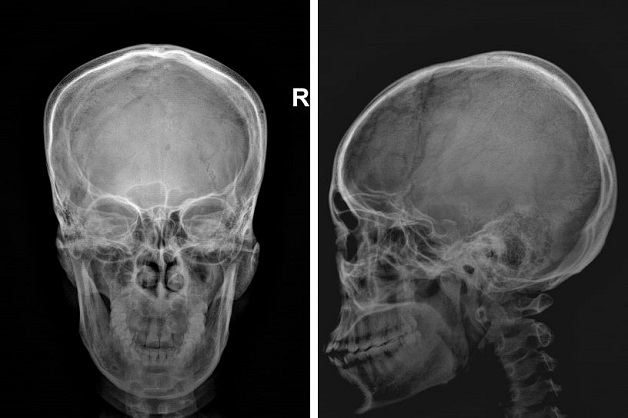 Chụp x quang sọ não - Phương pháp chẩn đoán hình ảnh hệ thần kinh 
