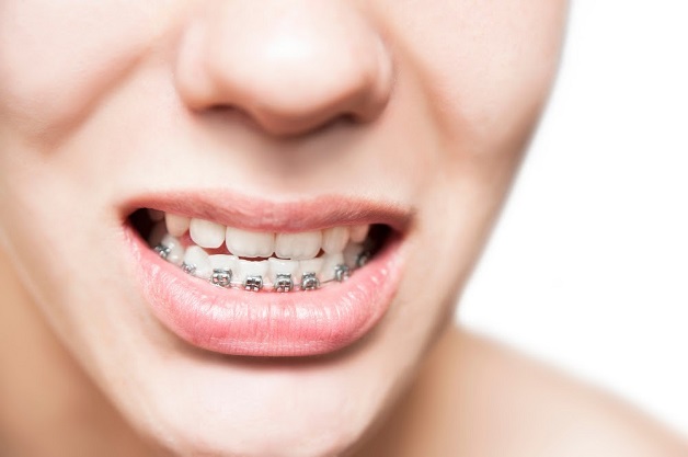 Chi phí niềng răng 1 hàm với mỗi phương pháp sẽ có sự khác nhau