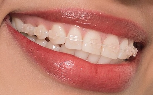 Niềng răng 1 hàm thường chỉ áp dụng cho những trường hợp tương quan hai hàm vẫn đảm bảo cân đối, hài hòa