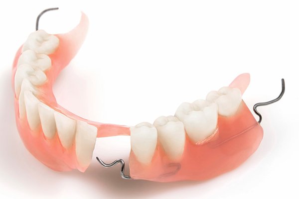Phương pháp trồng răng hàm bằng hàm giả tháo lắp truyền thống