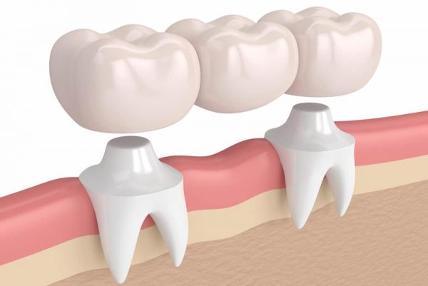Trồng răng hàm bằng phương pháp bắc cầu răng sứ hiện đại