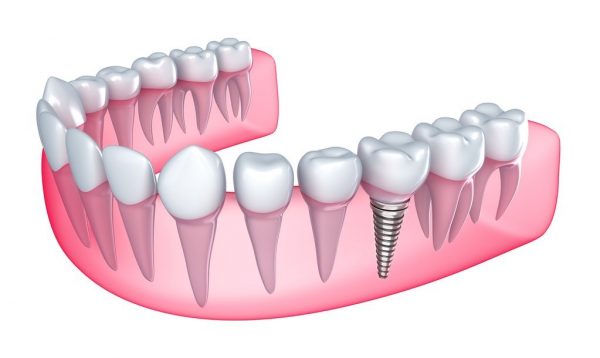 Phương pháp cấy ghép Implant được áp dụng trong phục hình răng hàm bị mất