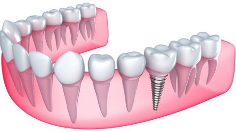 Tìm hiểu về chi phí trồng răng hàm tại nha khoa hiện nay