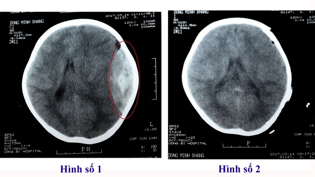 chụp cắt lớp vi tính sọ não - phương pháp chẩn đoán hình ảnh hệ thần kinh