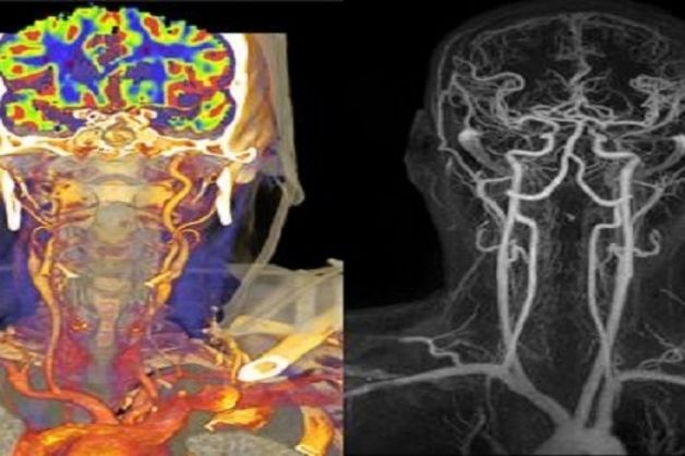 Chẩn đoán khối u não trong não thông qua hình ảnh chụp mạch máu não