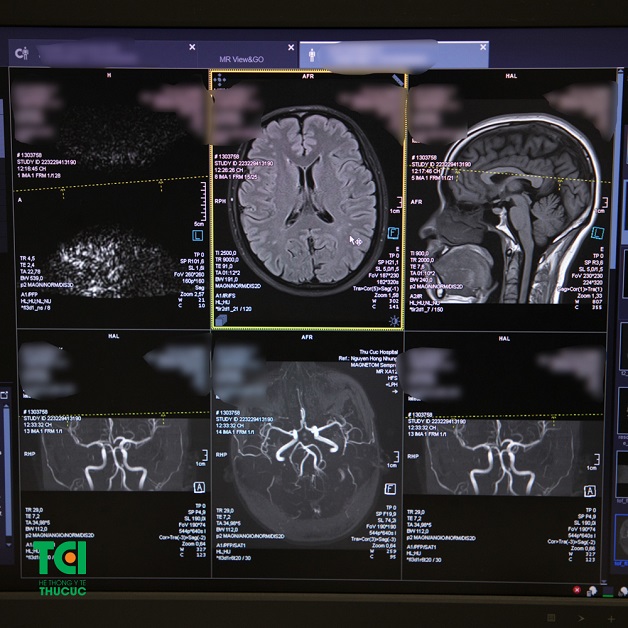 Chụp MRI não là gì? Vì sao nên chụp MRI não? 