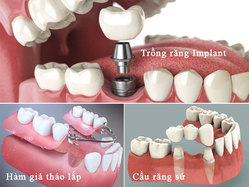 Có 3 phương pháp trồng răng giả được áp dụng phổ biến là hàm giả tháo lắp,cầu răng sứ và trồng răng giả implant