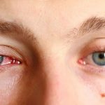 Bệnh đau mắt đỏ có lây không và cách chữa bệnh hiệu quả