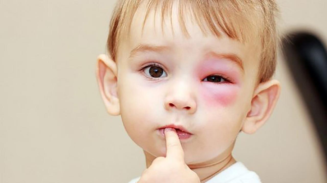 Làm sao để chăm sóc em bé bị đau mắt đỏ?
