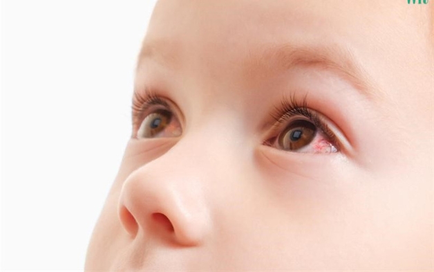 Đau mắt đỏ ở trẻ nhỏ xảy ra khi kết mạc bị viêm nhiễm, khiến cho mắt có hiện tượng đỏ ửng, đau rát và có dấu hiệu sưng.