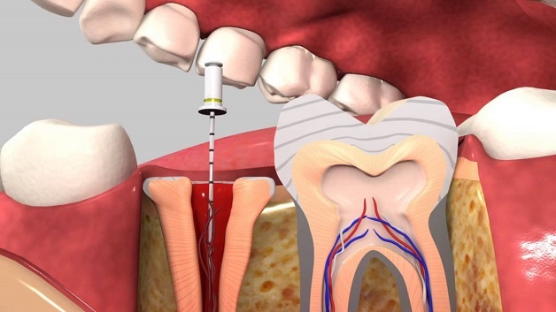 Viêm quanh cuống răng là tình trạng viêm ở tổ chức quanh chóp của răng sau khi tủy đã chết