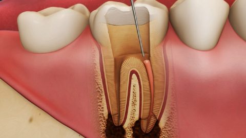 Điều trị viêm quanh cuống răng thế nào?