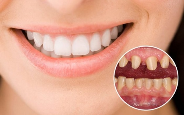 Bọc răng sứ là phương pháp hiệu quả để cải thiện những khiếm khuyết ở răng miệng