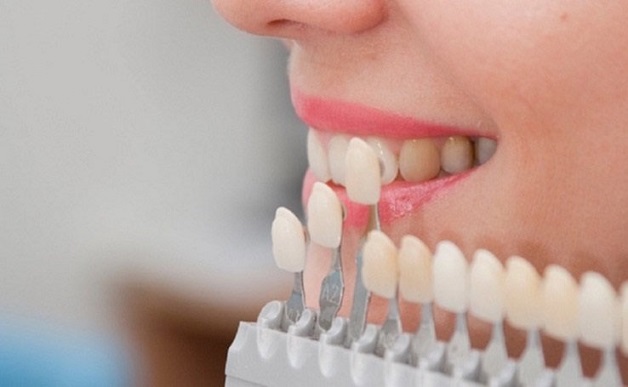 Giá bọc răng sứ ở mỗi loại răng sứ sẽ có sự khác nhau