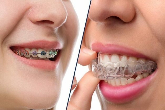 Ngày nay, niềng răng được cải tiến thành nhiều hình thức đa dạng đáp ứng nhu cầu của mọi khách hàng