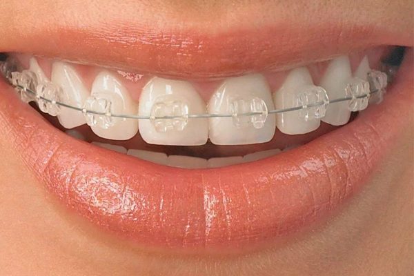Lực tác động của mắc cài sứ lên răng tương đối ổn định, giúp điều chỉnh nha hiệu quả