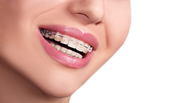 Nắn chỉnh răng là giải pháp khắc phục tình trạng lệch lạc ở hàm răng bằng khí cụ chuyên dụng