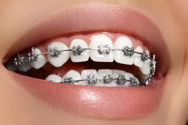 Niềng răng bằng mắc cài kim loại có ưu điểm cao về tính tối ưu thời gian do khả năng chỉnh nha vượt trội