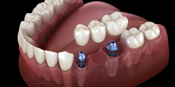 Răng Implant giúp khôi phục hoàn toàn lực nhai và ngăn chặn tình trạng tiêu xương hàm hiệu quả