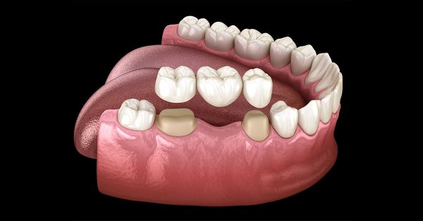 Phương pháp bắc cầu răng sứ phục hình từ 1-2 chiếc răng bị mất