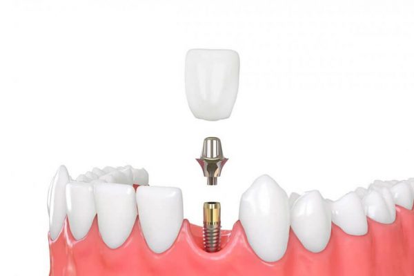 Kỹ thuật cấy ghép Implant sử dụng răng giả có kết cấu tương tự như răng thật để phục hồi răng đã mất