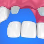 Giá trồng răng cửa hiện nay tại nha khoa
