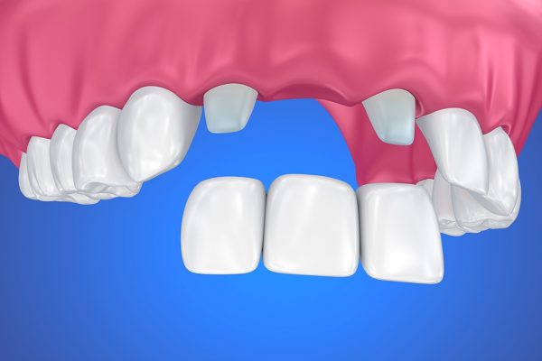 4. Giá trồng răng cửa cao bao nhiêu hiện nay? Giá trồng răng cửa hiện nay có thể dao động từ vài trăm nghìn cho tới vài chục triệu đồng/răng. Phương pháp thực hiện là yếu tố chính quyết định sự chênh lệch rõ rệt về chi phí đến như vậy. Với phương pháp dùng hàm giả tháo lắp, mọi người chỉ cần chi trả mức phí khoảng vài trăm nghìn đồng. Trong khi đó, một chiếc răng Implant có thể có mức giá lên tới hàng chục triệu đồng tùy chất liệu. Bên cạnh đó, tình trạng sức khỏe răng miệng cũng sẽ quyết định một phần chi phí người bệnh phải bỏ ra khi muốn trồng răng cửa. Nếu mắc bệnh lý răng miệng, bác sĩ sẽ chỉ định điều trị bệnh lý trước khi tiến hành trồng răng để đạt hiệu quả phục hình nha khoa cao nhất. Mức giá trồng răng ở các cơ sở nha khoa có thể khác nhau do trình độ chuyên môn, tay nghề của bác sĩ cũng như trang thiết bị y tế thực hiện thủ thuật trồng răng. Trồng răng là kỹ thuật khó, đòi hỏi bác sĩ phải có chuyên môn sâu dày, kết hợp máy móc hiện đại, tiên tiến. Do đó, việc lựa chọn cơ sở nha khoa uy tín để trồng răng là cách tốt nhất giúp bạn đảm bảo an toàn, hiệu quả cũng như chí phí bản thân phải bỏ ra để sở hữu hàm răng hoàn hảo, nụ cười tự tin. Như vậy, xét trên nhiều yếu tố thì giá trồng răng cửa có thể dao động từ hàng trăm tới hàng chục triệu đồng. Bạn nên liên hệ trực tiếp với các nha khoa uy tín để được bác sĩ có chuyên môn thăm khám, tư vấn phương pháp trồng răng phù hợp để tiết kiệm chi phí tối đa. 