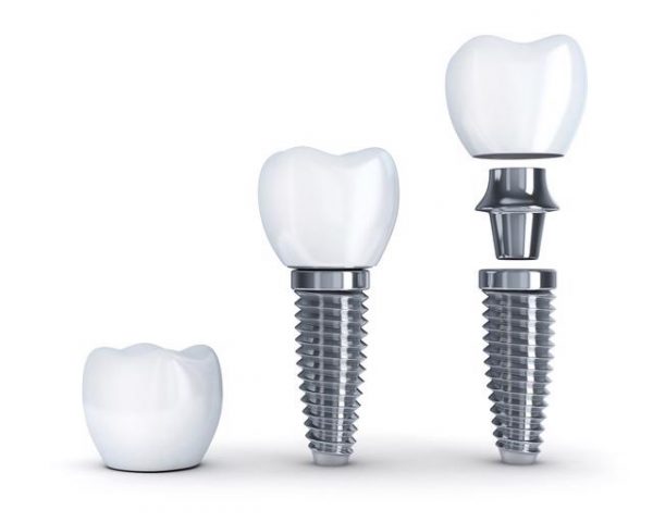 Răng Implant hiện nay tại Hàn không chỉ chắc chắn mà còn thẩm mỹ và luôn được nhiều người lựa chọn