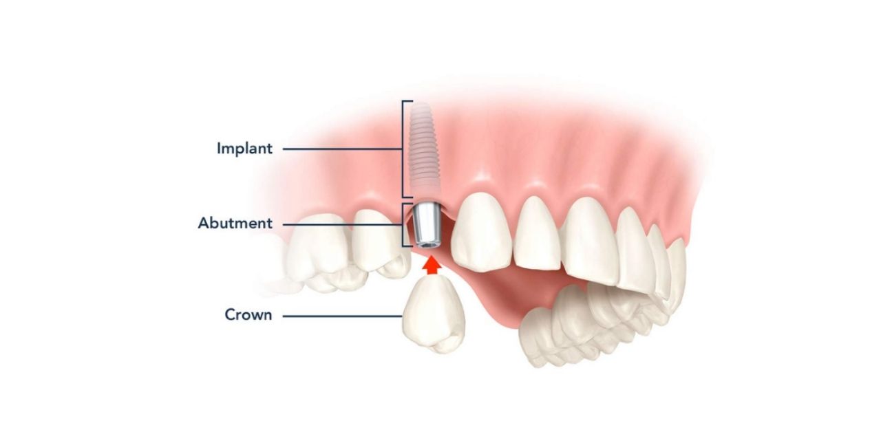 Trồng răng khểnh bao nhiêu tiền qua phương pháp bắc cầu răng sứ? 
