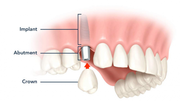 Implant có cấu tạo bao gồm trụ titanium như một chiếc chân răng thật với khớp nối abutment và mão răng sứ