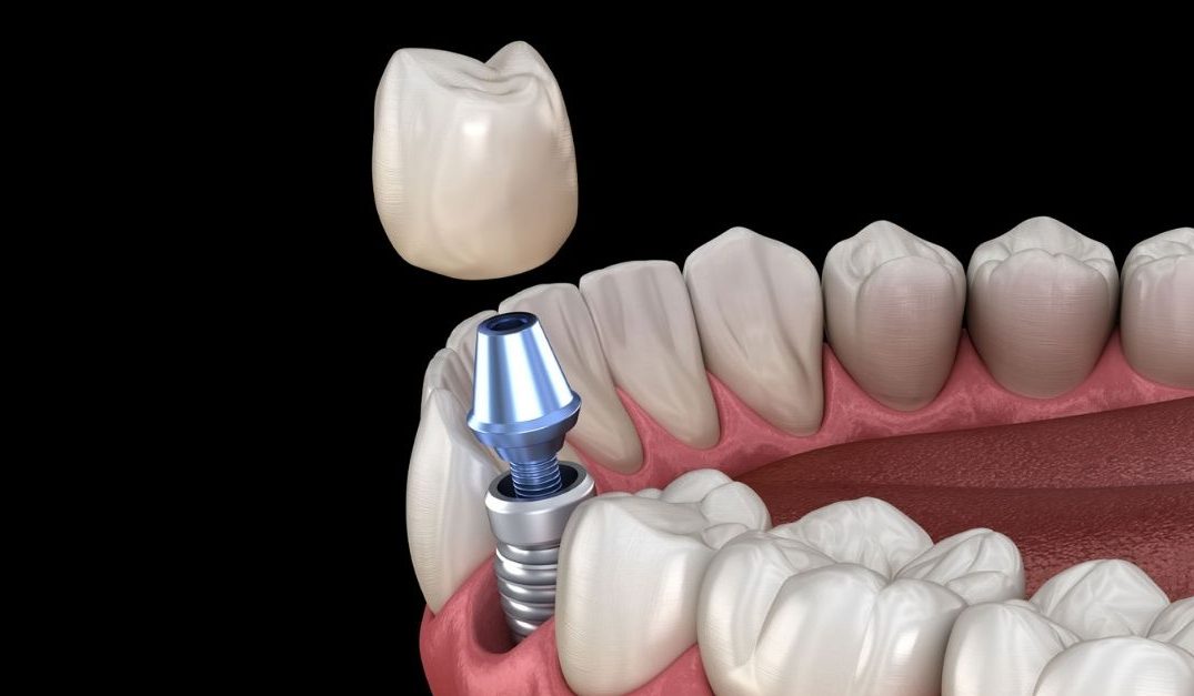 Keo dán răng sứ vĩnh viễn có thể được sử dụng trong mọi trường hợp nha khoa không?
