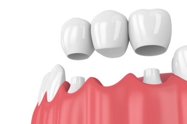 Trồng răng vĩnh viễn bằng phương pháp bắc cầu răng sứ hiện đại, thẩm mỹ