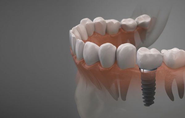 Trồng răng bằng kỹ thuật cấy ghép Implant tiên tiến, hiệu quả dài lâu