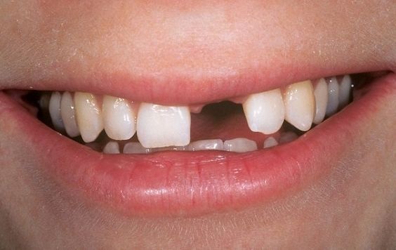 Hàm răng không hoàn chỉnh khiến bạn gặp khó khăn trong ăn nhai, và thiếu tự tin khi giao tiếp
