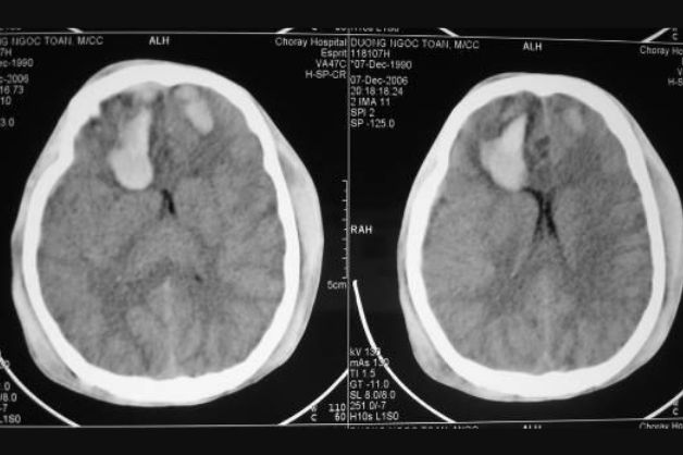 Chụp CT sọ não phát hiện các dấu hiệu bất thường ở não