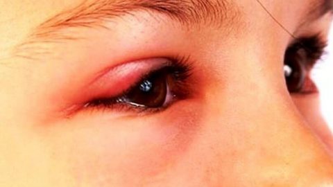 Cần làm gì khi bị lẹo ở mắt? Nguyên nhân và cách điều trị