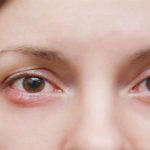 Làm sao để phòng tránh lẹo mắt tái phát?