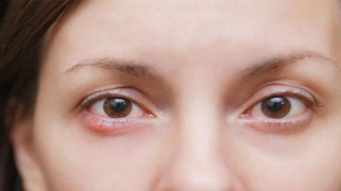Làm sao để phòng tránh lẹo mắt tái phát?