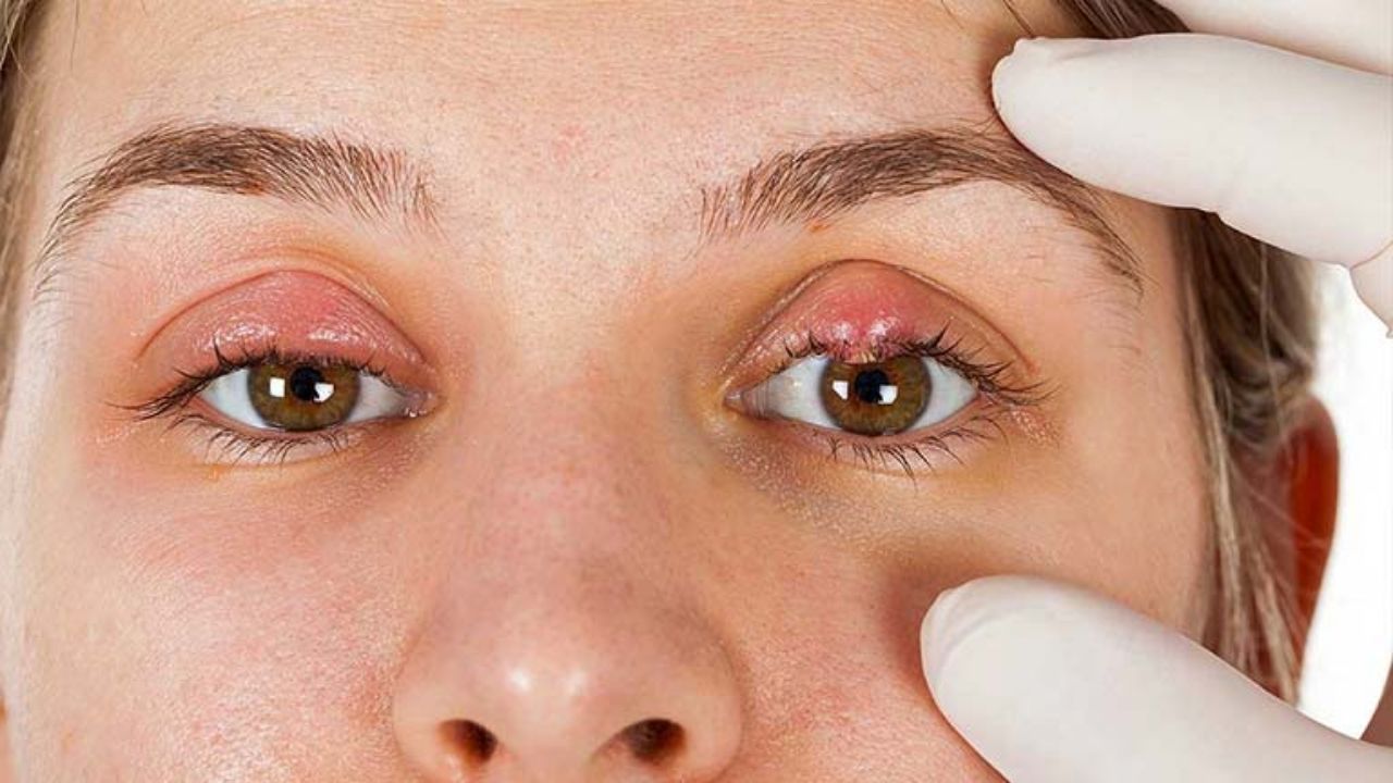 Nguyên nhân và cách điều trị mắt bị lẹo có mủ hiệu quả
