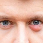 Dấu hiệu lẹo mắt như thế nào, các chữa trị và phòng tránh