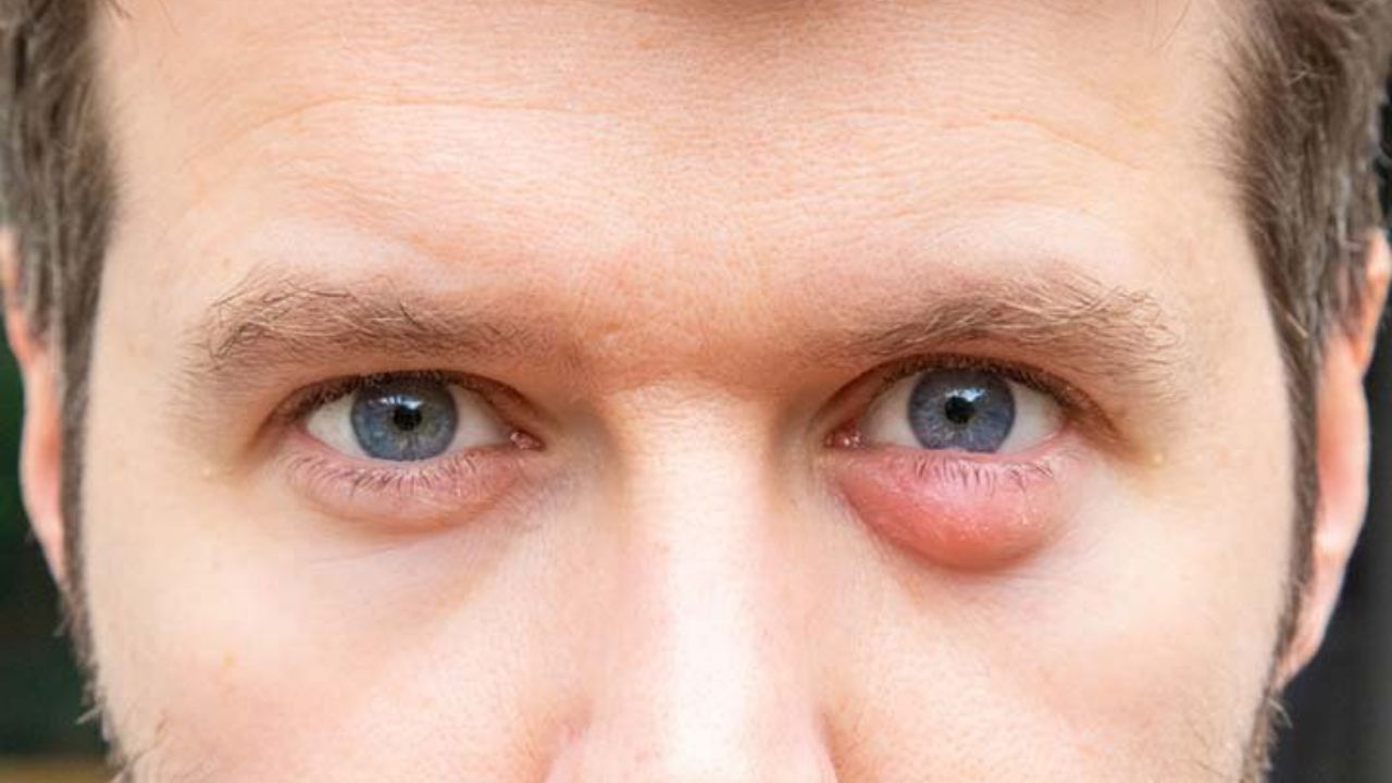 Có cách nào để phòng ngừa lẹo mắt không?
